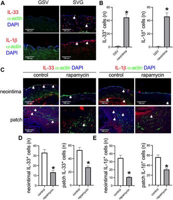 A Novel Plant Leaf Patch Absorbed With IL-33 Antibody Decreases Venous Neointimal hyperplasia